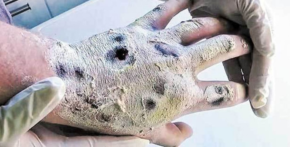 Imatge de la mà d'un pacient que s'ha injectat Krokodile