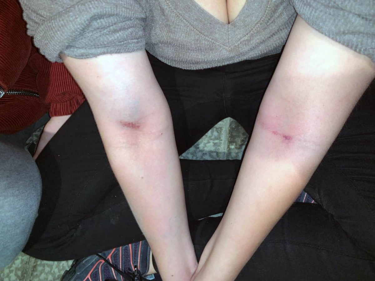 Una de les joves ferides per l'atac feixista d'aquesta matinada a Sant Celoni