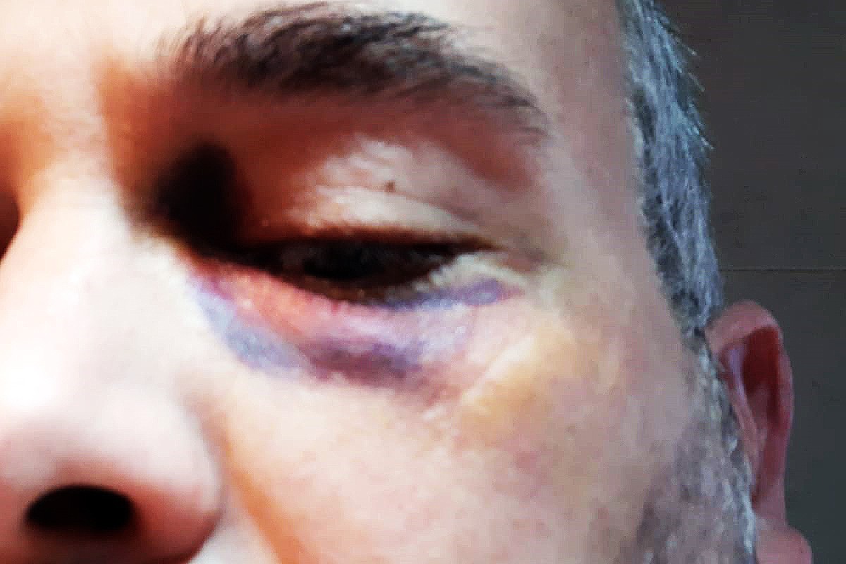 Blau a l'ull del treballador de FCC, en una de les conseqüències més visibles de l'agressió