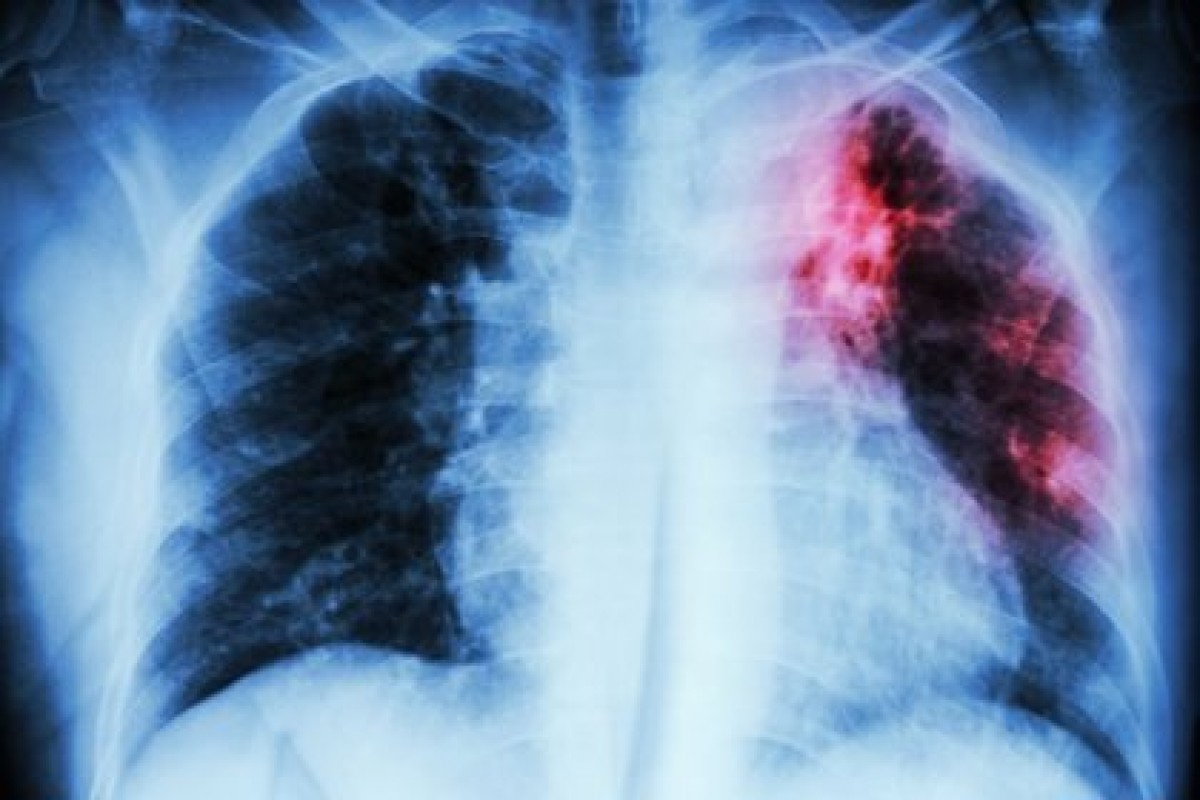 Una imatge d'un càncer de pulmó