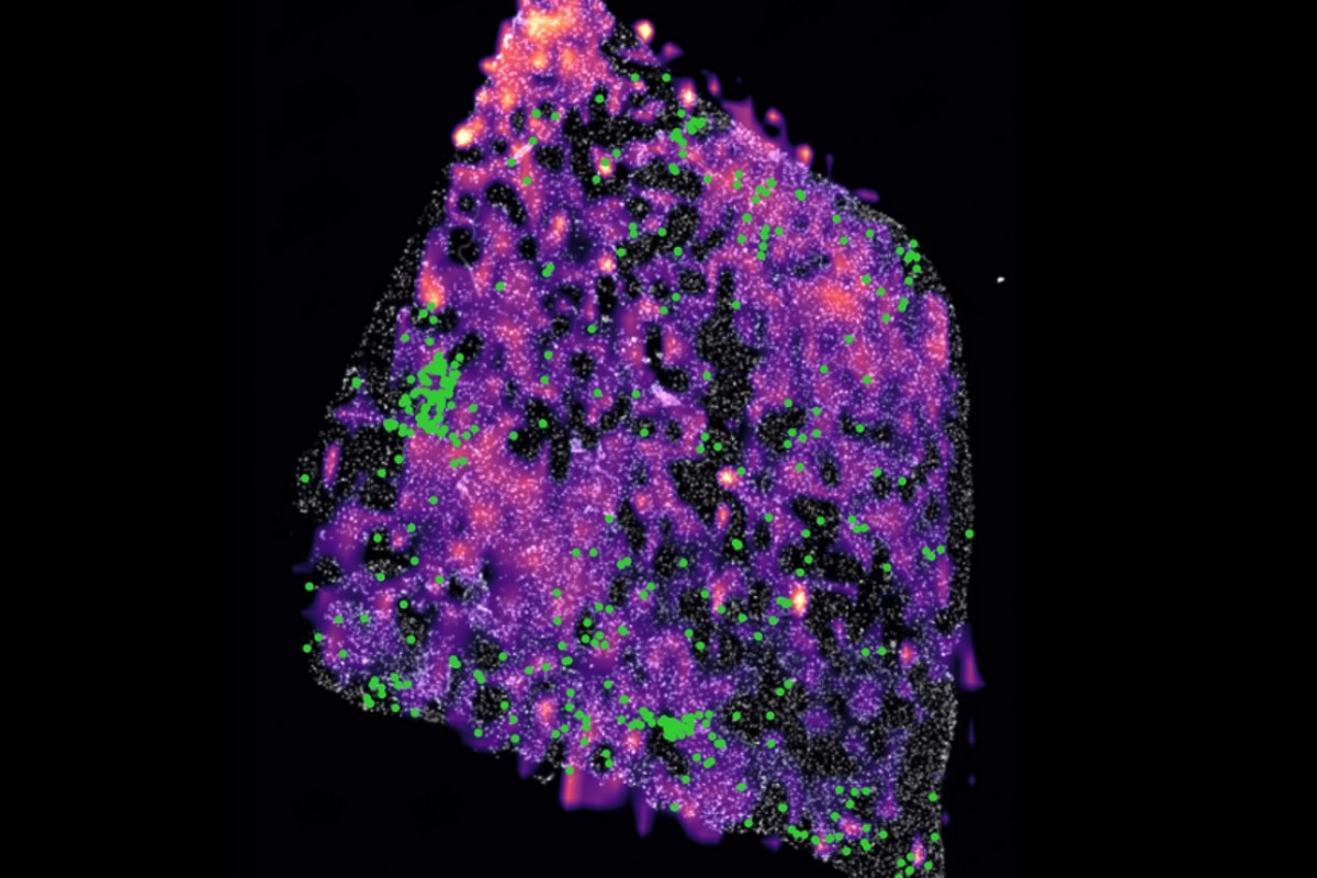Tumor de glioma humà amb una mutació que mostra grups de cèl·lules T en verd i els punts rosa representen concentracions del metabòlits D-2HG  