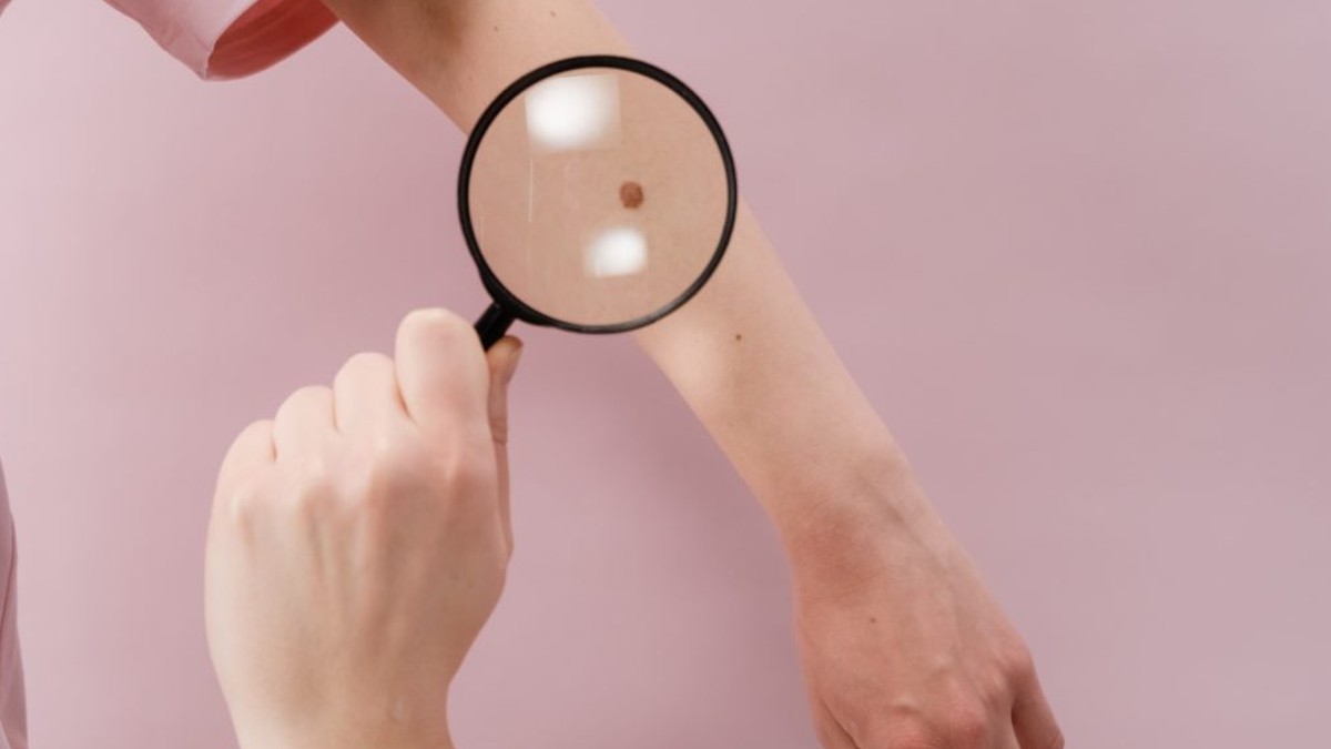 El melanoma és una malaltia complexa en què la resposta a tractaments és limitada