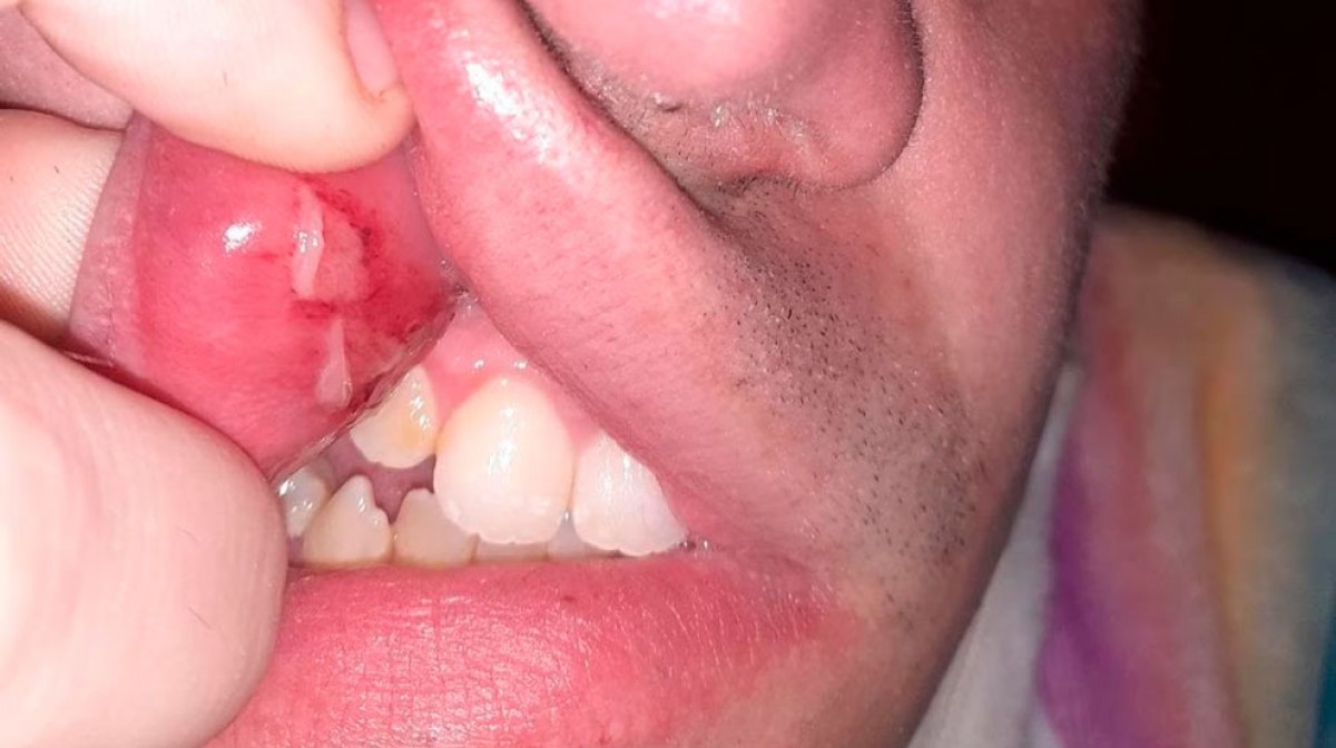 Una de les ferides a la boca d'un dels joves agredits.