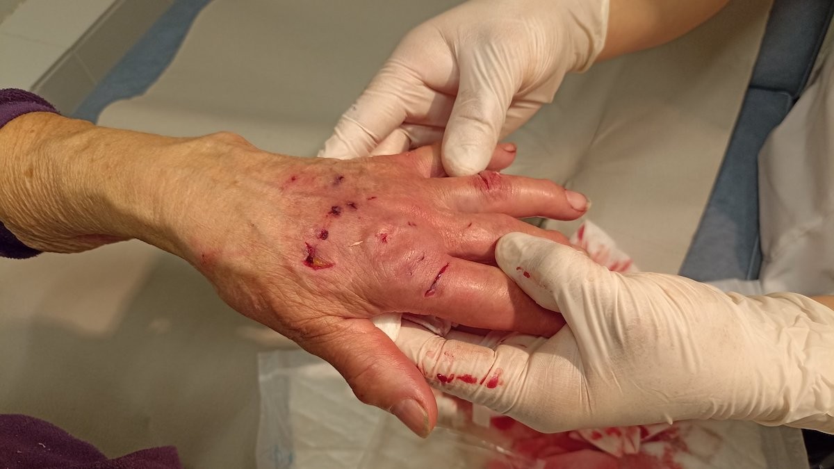 Imatge de les ferides provocades pel gos en una mà de la víctima